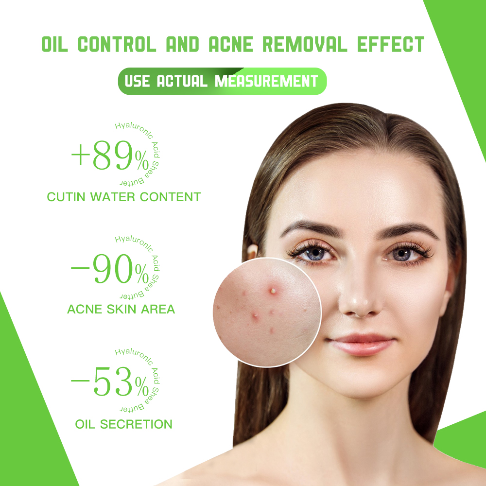 Disaar Anti-Acne Facial Serum - 50ml Disaar