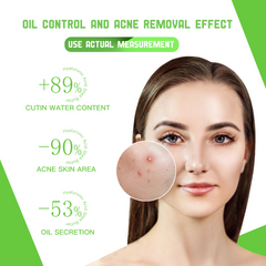 Disaar Anti-Acne Facial Serum - 50ml Disaar