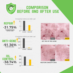 Disaar Anti-Acne Facial Serum - 50ml Disaar