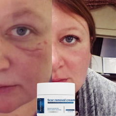 Lanthome Scar Removal Cream - 30g LANTHOME