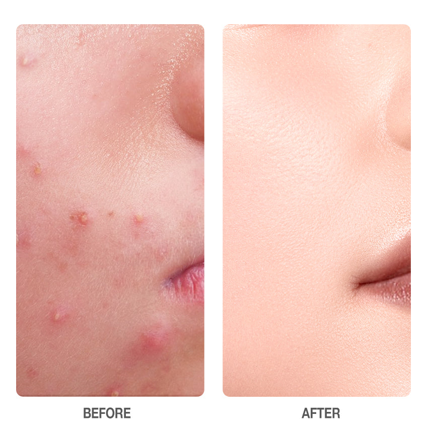 Skinever Salicylic Acid Acne Treatment Ice Sleep Mask Skinever
