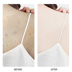 Skinever Salicylic Acid Weightless Exfoliating Body Lotion - 100ml Skinever