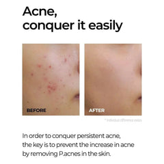 Some By Mi MIRACLE AC CLEAR SPOT TREATMENT - 10g SOME BY MI