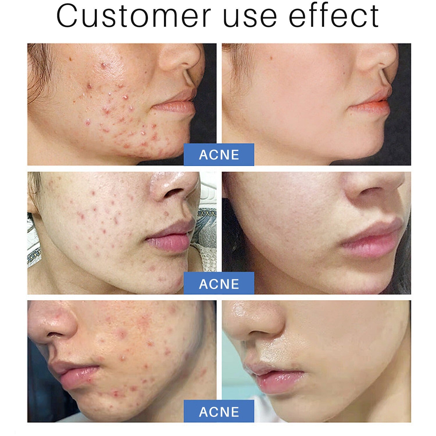 Lanthome Acne Cover Patch For Sports LANTHOME