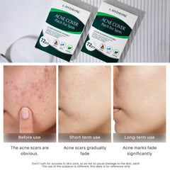 Lanthome Acne Cover Patch For Sports LANTHOME