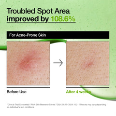 Anua Azelaic Acid 10+ Hyaluron Serum - 30ml Anua