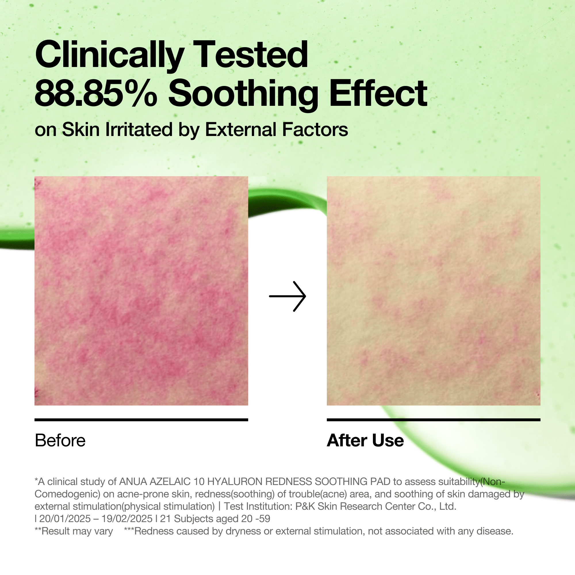 Anua Azelaic Acid 10 Hyaluron Redness Soothing Pad – 230ml (90 ea) Anua
