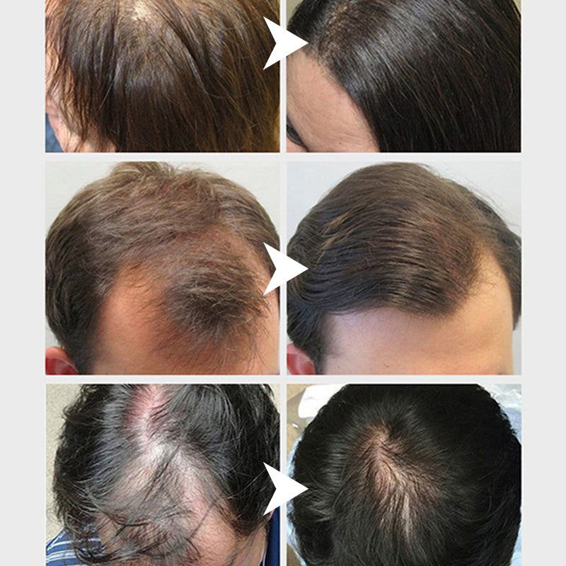 Sauvasine Onion Oil For Hair Growth - 100ml Sauvasine