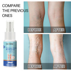 Sauvasine Varicose Veins Relief Spray - 30ml Sauvasine
