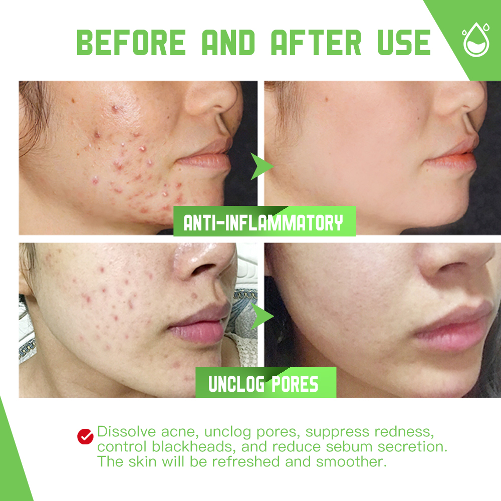 Disaar Anti-Acne Facial Serum - 50ml Disaar