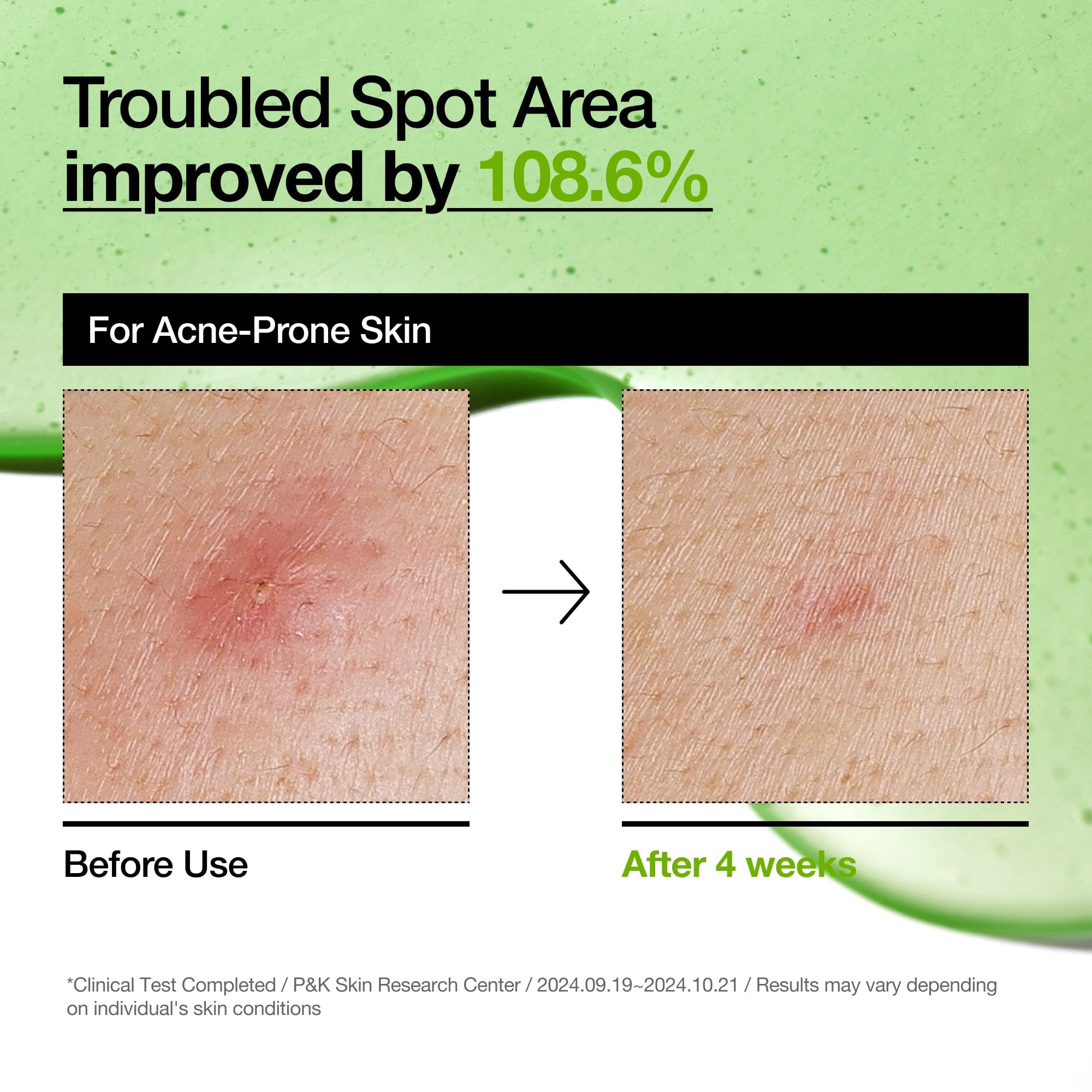 Anua Azelaic Acid 10+ Hyaluron Serum - 30ml Anua